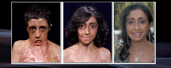 After before down facial photo surgery syndrome Pussy grinding in scissor position
